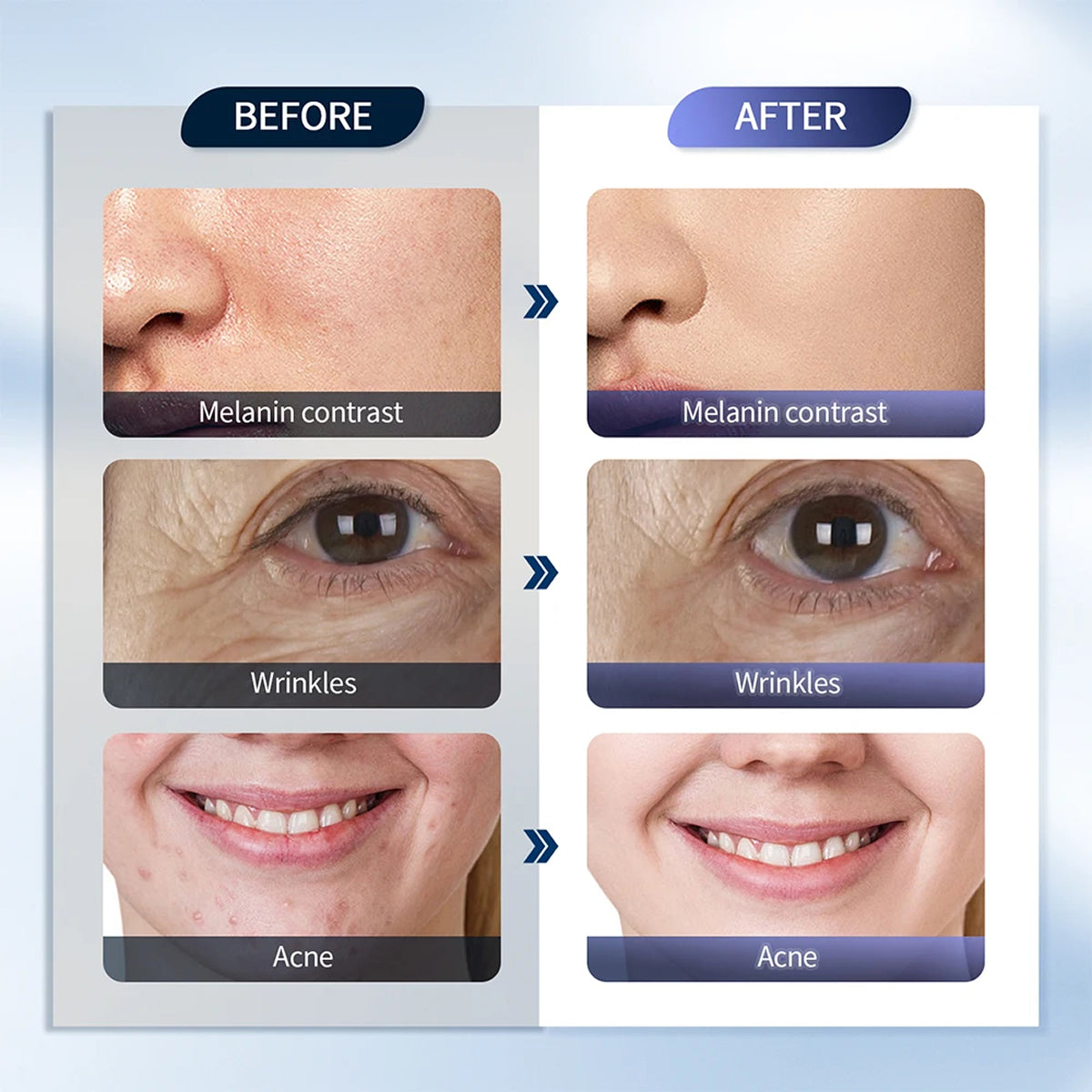 Blue Light Therapy Device for Acne and Skin Care - Facial Treatment Lamp